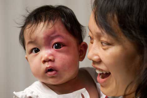baby with facial stain birthmark